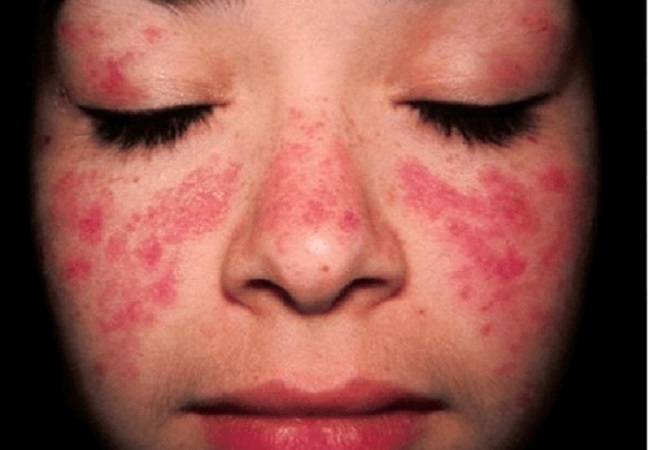 Triệu chứng của bệnh lupus ban đỏ hệ thống